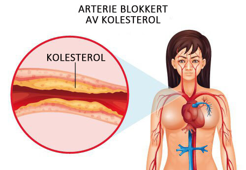 Hvordan kontrollere kolesterolnivået ditt