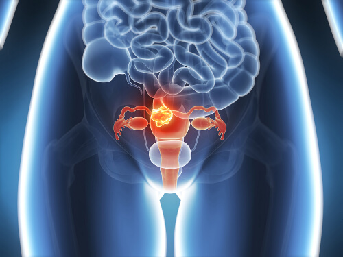 Endometriose kan være en årsak til uregelmessig menstruasjon