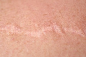 Hvordan bruke løk for å minske arr