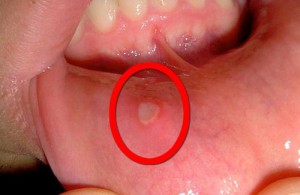 Aftøs stomatitt: Hjemmelagde midler