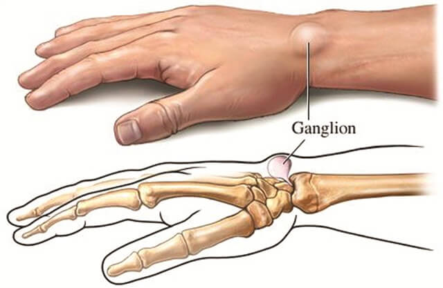 ganglion-cyste