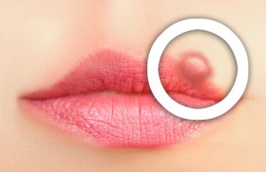 Hvordan forhindre utbrudd av herpes labialis