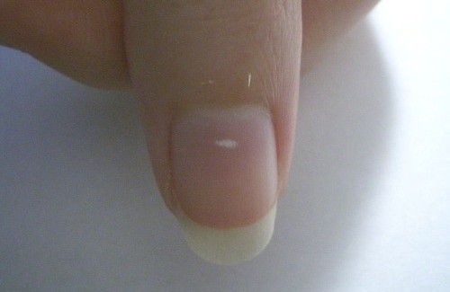 Hva betyr hvite merker på fingerneglene?