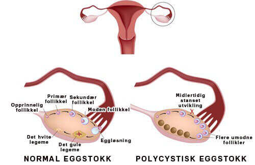 Hva er polycystisk ovariesyndrom og hvordan kan det behandles?