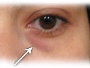 Hjemmebehandling av hovne øyne