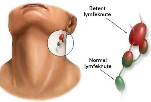 Hva forårsaker betente lymfekjertler?