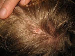 Hvordan fjerne lus på en naturlig måte