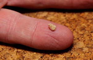 Hva forårsaker nyrestein? Årsaker og behandlinger