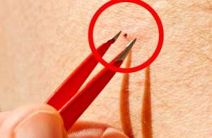 Flåttbitt: Farlig for både mennesker og dyr