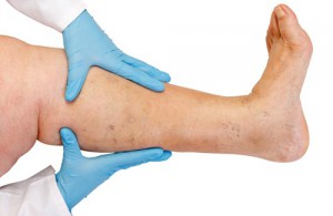 Forebygge væskeansamling: ti råd