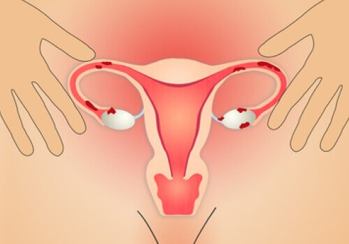 Behandling av endometriose med riktig ernæring