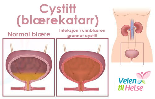 blærekatarr gir smerte ved vannlating