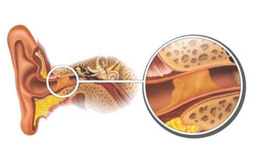 Hvordan fjerne ørevoks naturlig