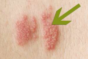 Helvetesild: hva er det og hvordan ser det ut?