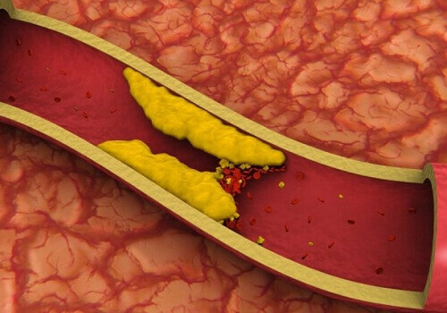 Hvordan kontrollere høyt kolesterol på en naturlig måte