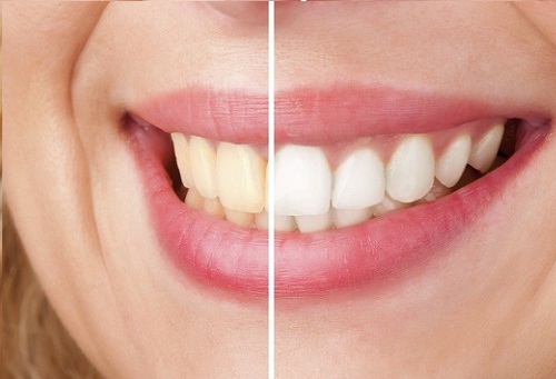4-teeth-white