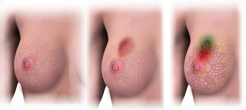 4 av 10 kreftsvulster kan unngås