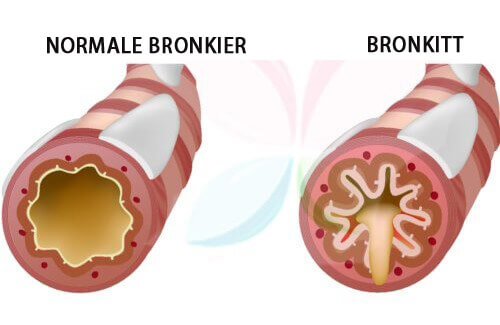 Bronkitt