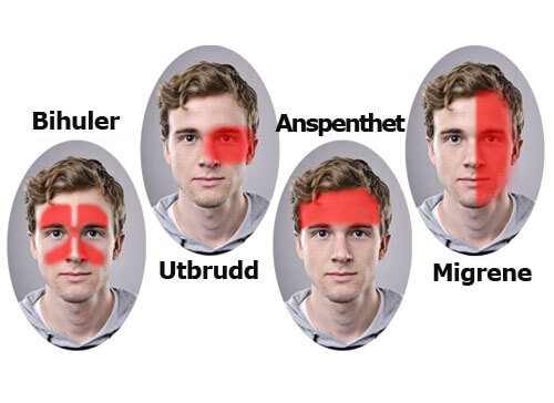 Ny og effektiv behandling av migrene