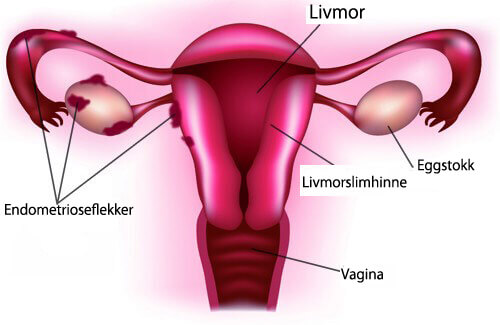 De viktigste symptomer på endometriose