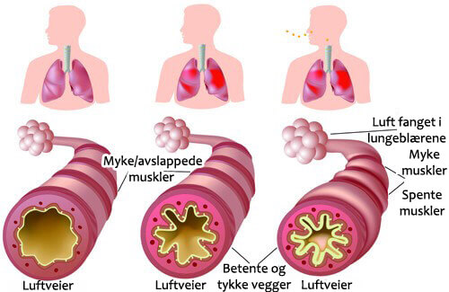 Hva skal du gjøre om du sliter med kronisk astma eller allergier