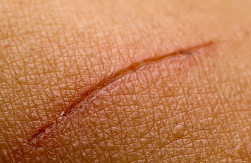 Behandling av arr: naturlige metoder