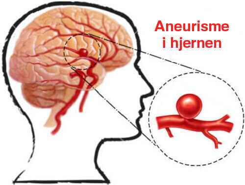Aneurisme i hjernen: Årsaker og forebygging