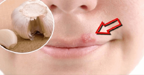 Hjemmelagde remedier for hurtig behandling av munnsår