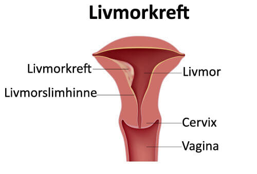 livmorkreft