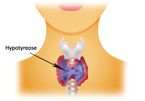 hypotyreose