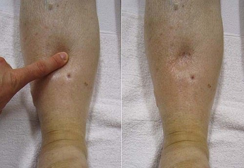 Ødem: Lær om faresignaler og årsaker