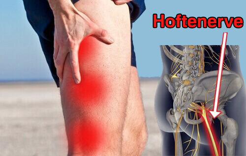 Naturlige hjelpemidler for å behandle isjias