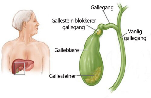 Hvordan kan jeg vite om jeg har gallesteiner?