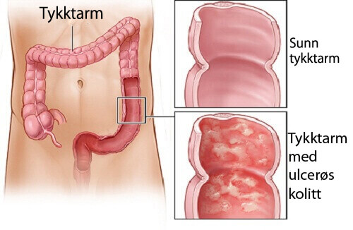 tykktarm