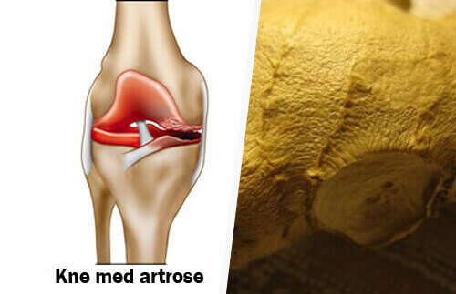 Hvordan du kan eliminere symptomene på artrose
