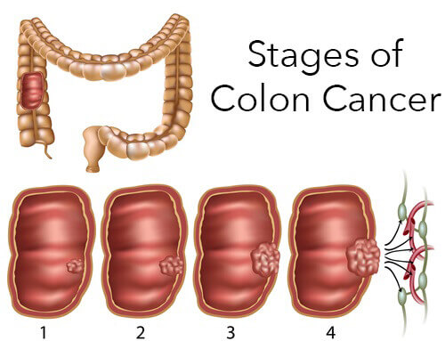 tykktarms- og endetarmskreft