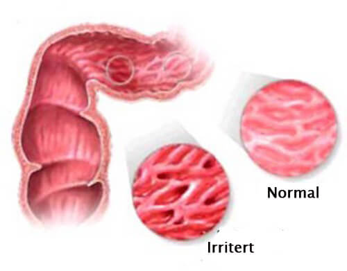4 tips for å lindre irritabel tarm-syndrom
