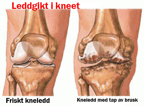 Symptomer på og forebygging av leddgikt