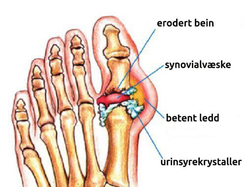 Fjern urinsyrekrystaller i leddene naturlig
