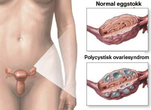 Polycystisk ovariesyndrom - Naturlige hjelpemidler