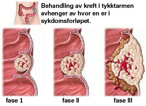 Det du trenger å vite om kreft i tykktarmen