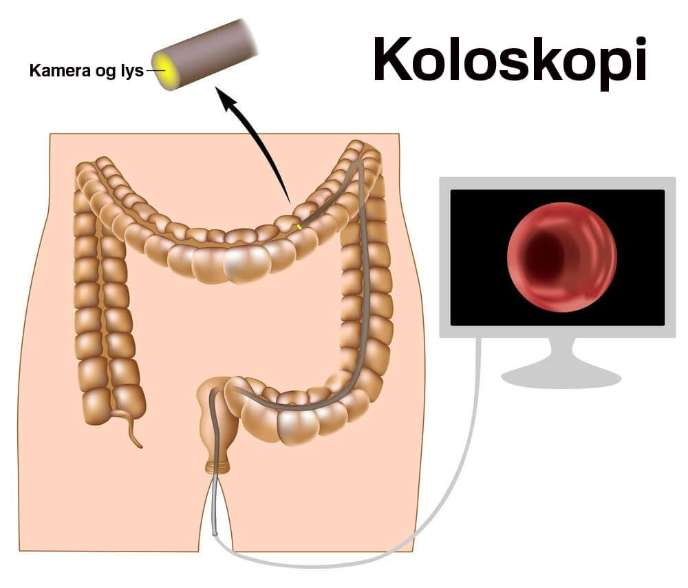 Koloskopi