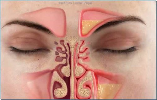 Hvordan lindre tett nese på under ett minutt