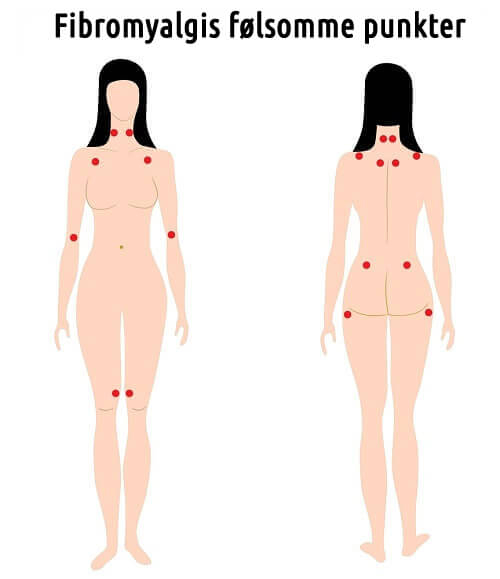 Punkter for å behandle fibromyalgi