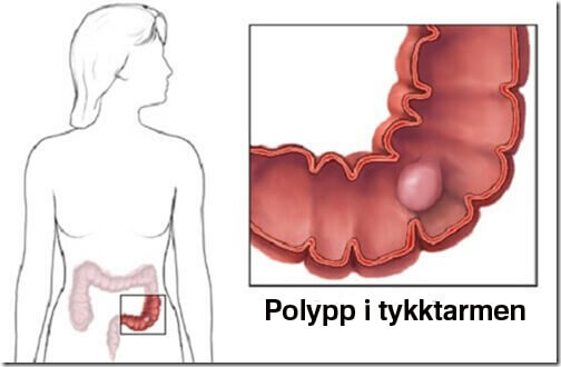 Fakta om polypper i tykktarmen Fakta om polypper i tykktarmen