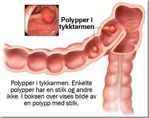 Polypper i tykktarmen