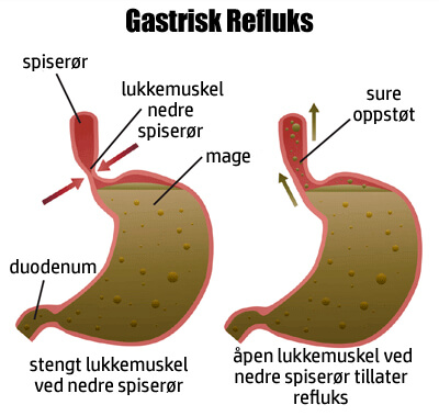gastrisk refluks