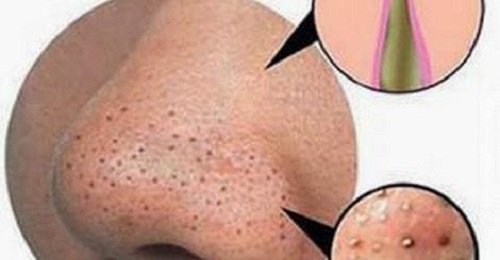 Naturlig fjerning av kviser og hudormer