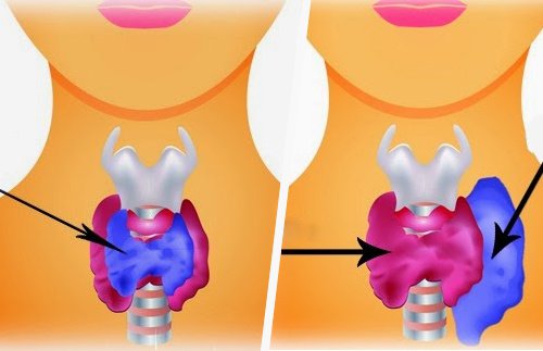Forskjellen mellom hypotyreose og hypertyreose