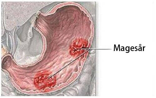 Lær om de ulike symptomene på magesår